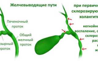 Холангит: лечение, симптомы, причины, диагностика