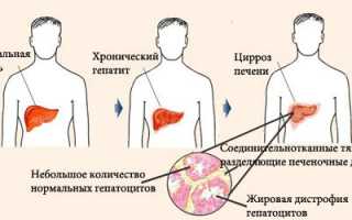 Лечение алкоголизма иглоукалыванием: вся правда о методе (с отзывами)