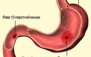 Причины и симптомы язвы двенадцатиперстной кишки, лечение, диета, народные средства
