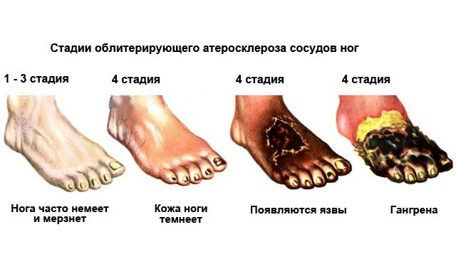Стадии атеросклероза ног