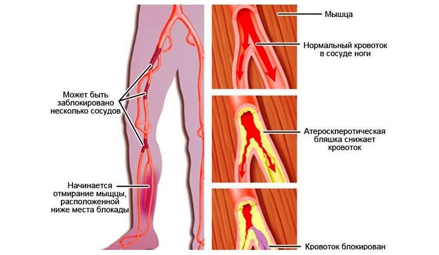 Атеросклероз ног